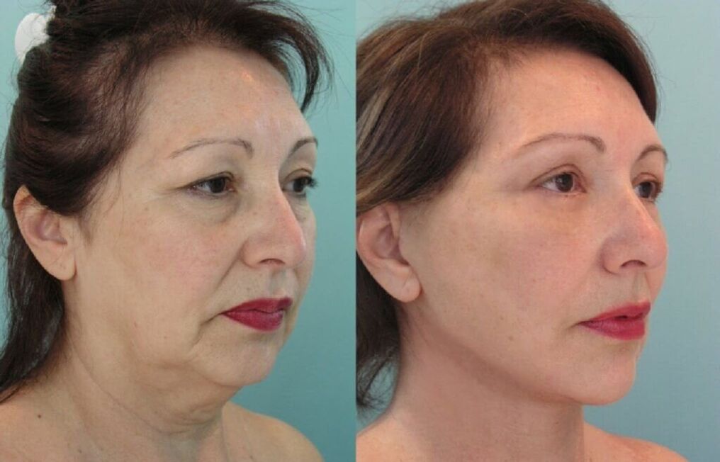 φωτογραφία πριν και μετά την αναζωογόνηση του δέρματος